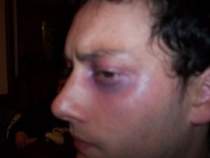 Black Eye - Model Thomas Haines