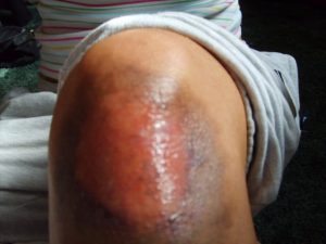 Knee Wound